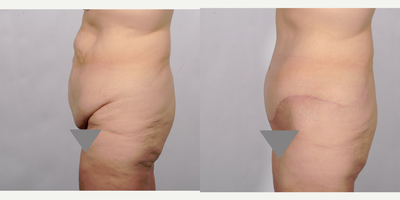 Tummy Tuck before and after photo