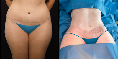 Body Lift before and after photo