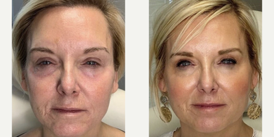 Dermal Fillers before and after photo