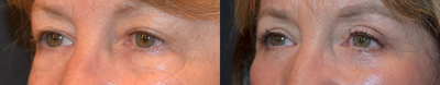 Eyelid Surgery before and after photo