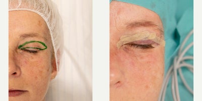 Eyelid Surgery before and after photo