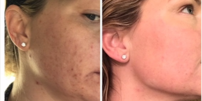 Fraxel Laser before and after photo