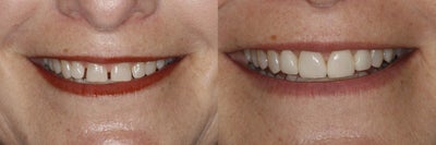 Porcelain Veneers before and after photo