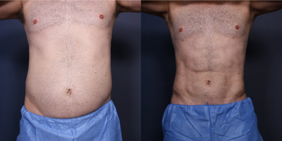 Liposuction before and after photo
