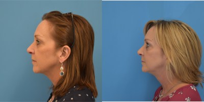 PrecisionTx before and after photo