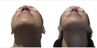 Septoplasty before and after photo