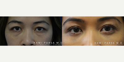 Double Eyelid Surgery before and after photo
