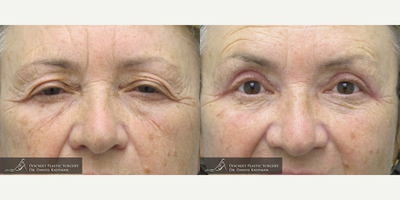 Eyelid Surgery before and after photo