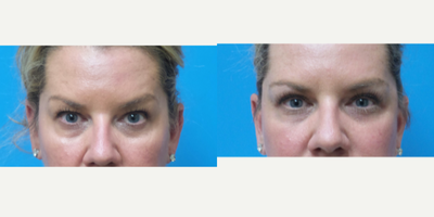 Eyelid Surgery before and after photo