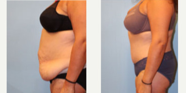 Liposuction before and after photo