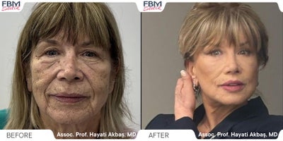 Neck Lift before and after photo