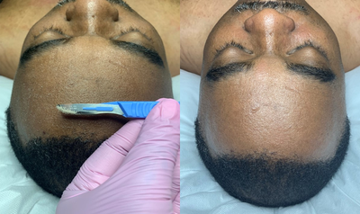 Dermaplaning before and after photo