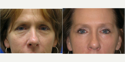 Eyelid Surgery before and after photo