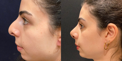 Revision Rhinoplasty before and after photo
