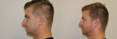 Rhinoplasty before and after photo