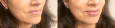 Volbella before and after photo