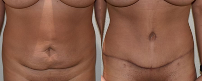 BodyTite before and after photo