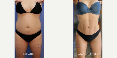 Brazilian Butt Lift before and after photo