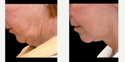 before and after image