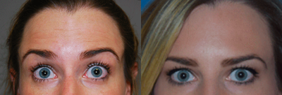 Botox before and after photo