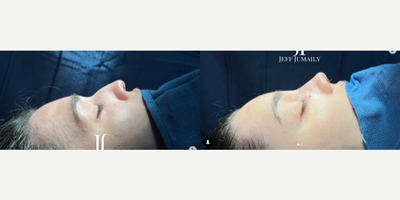 Brow Lift before and after photo