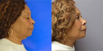 Facelift before and after photo