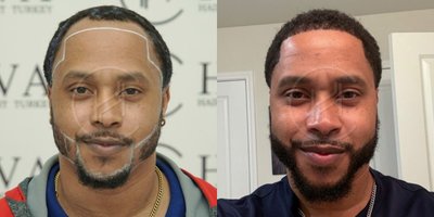 Hair Transplant before and after photo