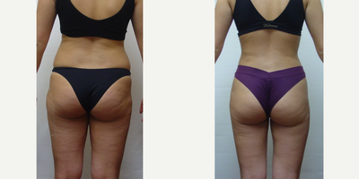 Liposuction before and after photo