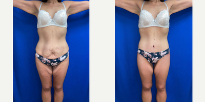 Mini Tummy Tuck before and after photo