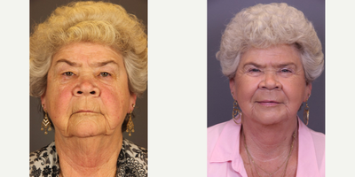Neck Lift before and after photo