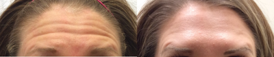 Botox before and after photo