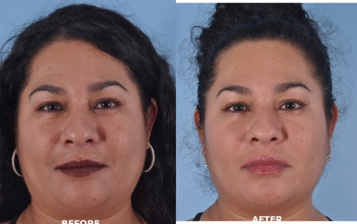 Botox before and after photo