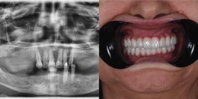 Dental Implants before and after photo
