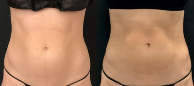 Emsculpt before and after photo