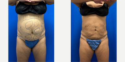 Emsculpt before and after photo