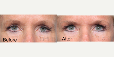 Eyelid Retraction Repair before and after photo