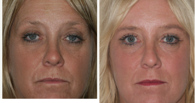 Laser Resurfacing before and after photo