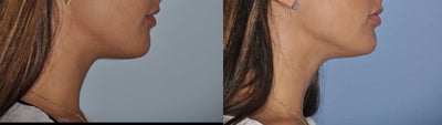 Lip Fillers before and after photo