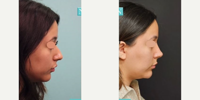 Nonsurgical Nose Job before and after photo