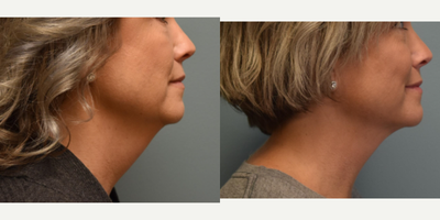 Chin Liposuction before and after photo