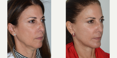 Deep Plane Facelift before and after photo