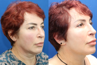 Facelift before and after photo