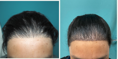 FUE Hair Transplant before and after photo