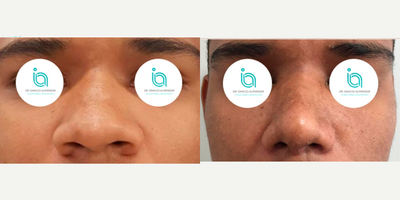 Rhinoplasty before and after photo