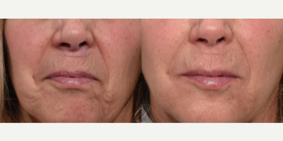 Botox before and after photo