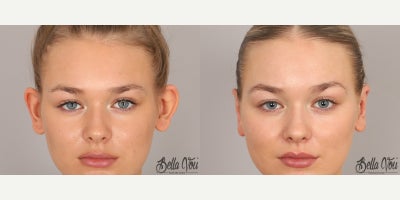 Ear Surgery before and after photo