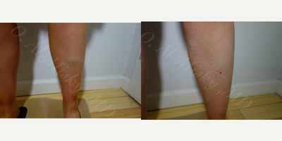 EVLT before and after photo