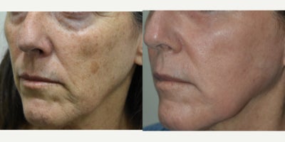 Laser Resurfacing before and after photo