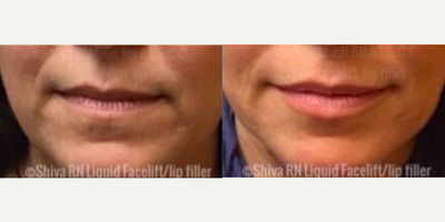 Liquid Facelift before and after photo
