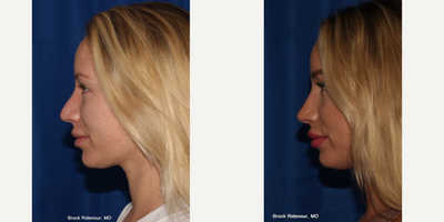 Rhinoplasty before and after photo